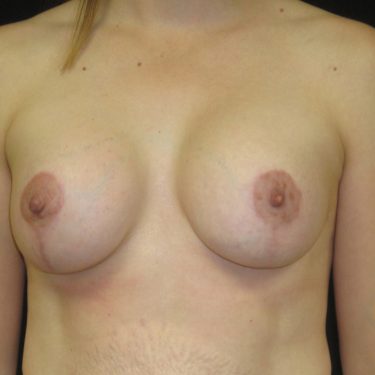 Breast Augmentation with Lift After Patient 16