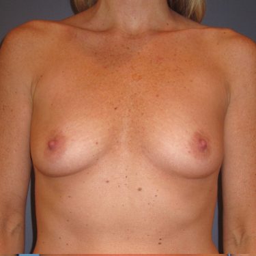 Breast Augmentation Before Patient 13