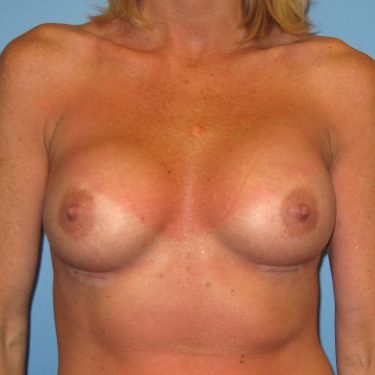 Breast Augmentation After Patient 13