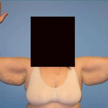 Brachioplasty Before Patient 6