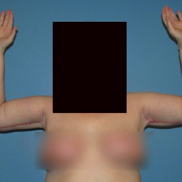 Brachioplasty After Patient 6