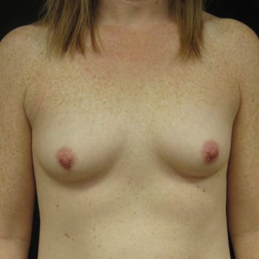 Breast Augmentation Before Patient 12