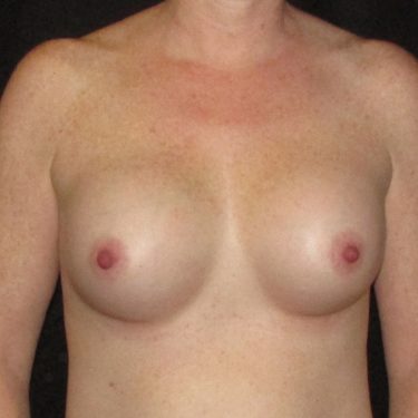 Breast Augmentation After Patient 12