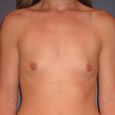 Breast Augmentation Before Patient 11