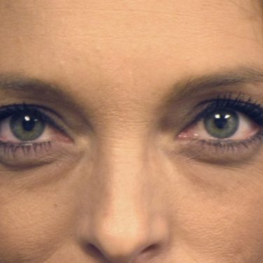 Eyes & Brow Before Patient 14