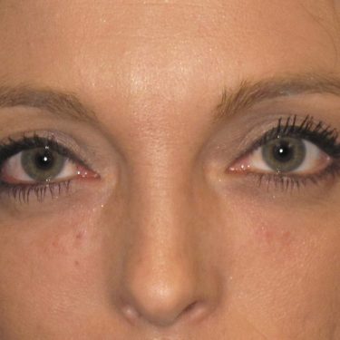 Eyes & Brow After Patient 14