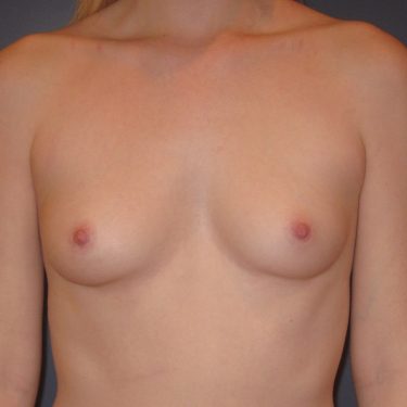 Breast Augmentation Before Patient 10