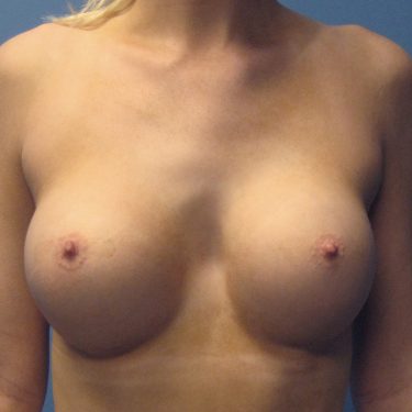 Breast Augmentation After Patient 10