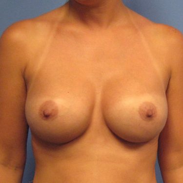 Breast Augmentation After Patient 9