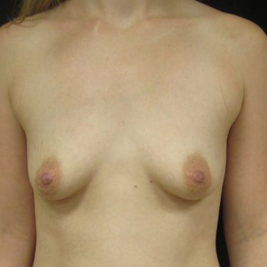 Dual-plane technique Before Patient 28