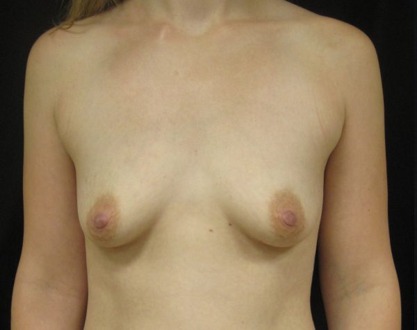 Breast Augmentation Before Patient 1
