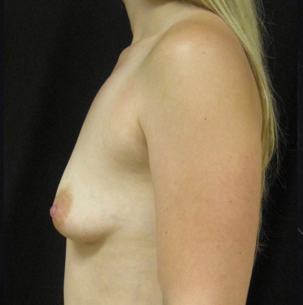 Breast Augmentation Before Patient 3