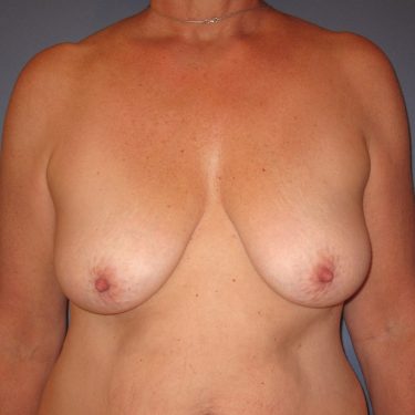 Breast Lift Before Patient 6