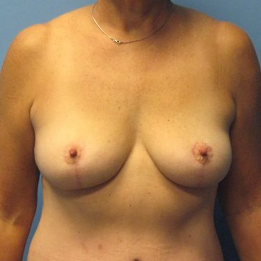 Breast Lift After Patient 6