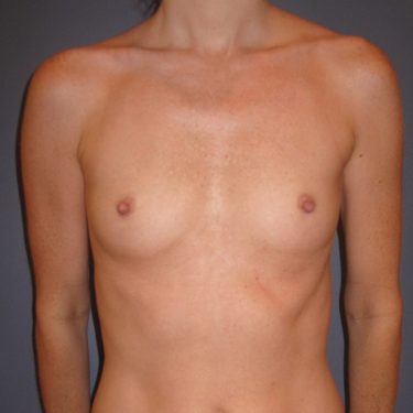 Breast Augmentation Before Patient 6
