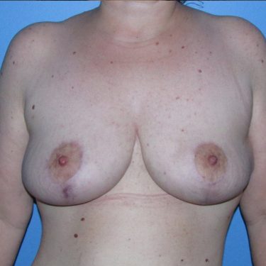 Breast Lift After Patient 5