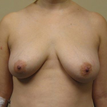 Breast Lift Before Patient 4