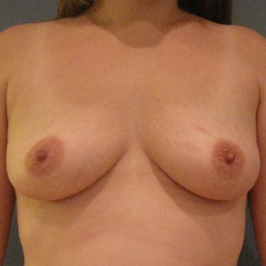 Subglandular Before Patient 20