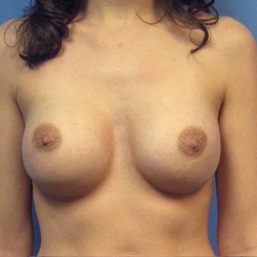 Breast Augmentation After Patient 4