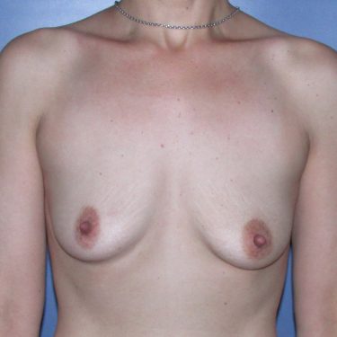 Dual-plane technique Before Patient 27