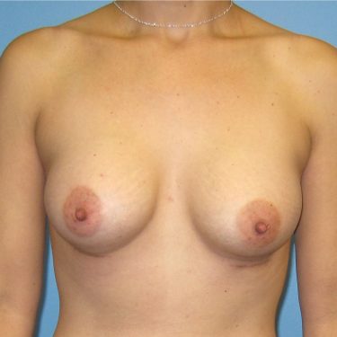 Dual-plane technique After Patient 27