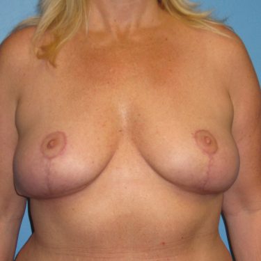 Breast Lift After Patient 2
