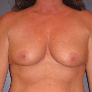 Subglandular Before Patient 19