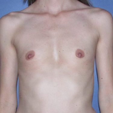 Pectus deformity Before Patient 10