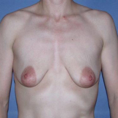 Breast Lift Before Patient 1