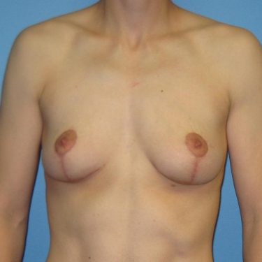 Breast Lift After Patient 1
