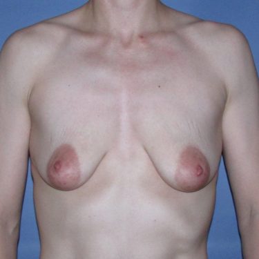 Breast Augmentation & Lift Before Patient 14