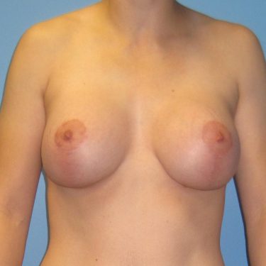 Breast Augmentation with Lift After Patient 15