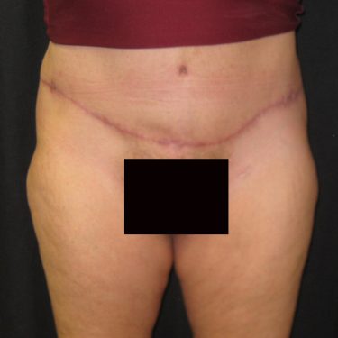 Surgery After Weight Loss After Patient 30