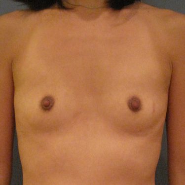 Breast Before Patient 4