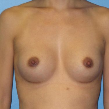 Breast After Patient 4