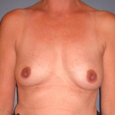 Breast Augmentation Before Patient 15