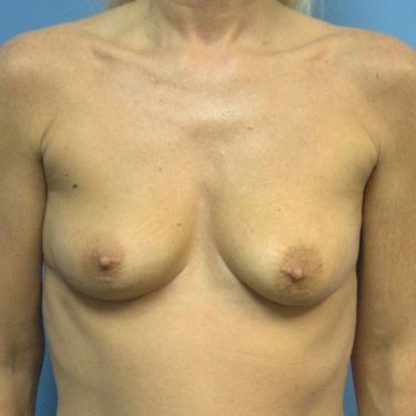 Dual-plane technique Before Patient 26