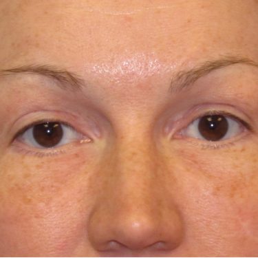 Eyes & Brow After Patient 13