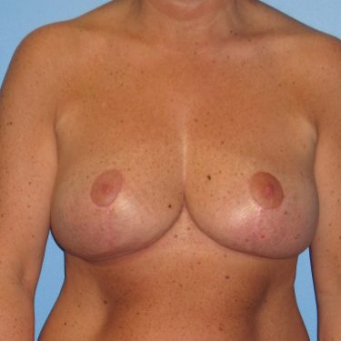 Revision of Others' Work After Patient 8