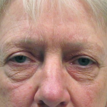 Eyes & Brow Before Patient 12