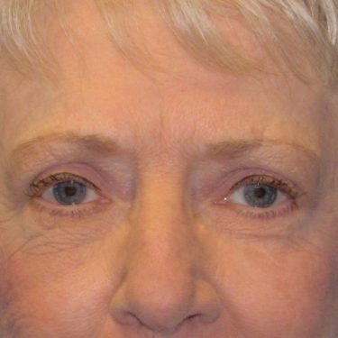 Eyes & Brow After Patient 12
