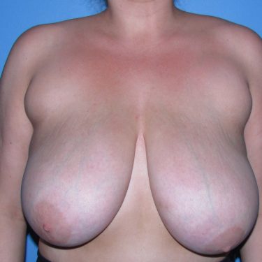 Breast Reduction Before Patient 17