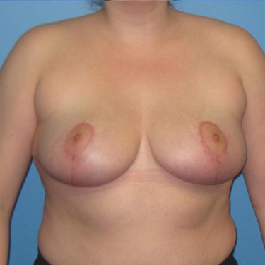 Breast Reduction After Patient 17