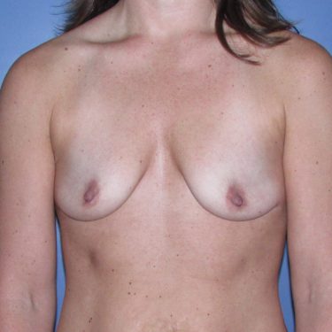 Subglandular Before Patient 18