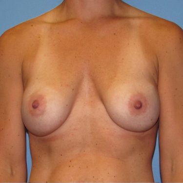 Subglandular After Patient 18