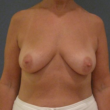 Subglandular Before Patient 17