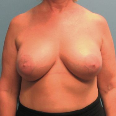 Subglandular After Patient 17