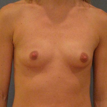 Breast Before Patient 30