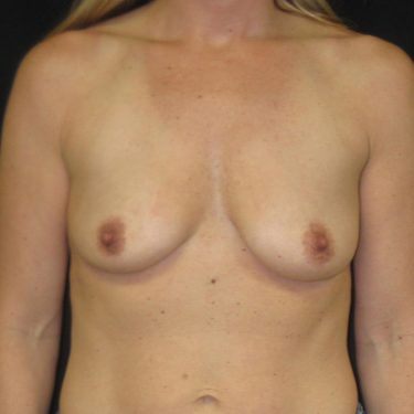 Subglandular Before Patient 16