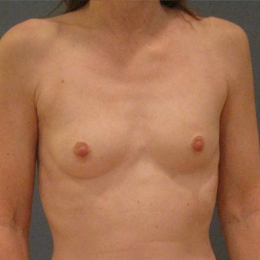 Breast Before Patient 28